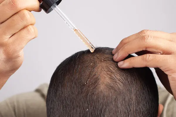 Oral Treatments for Hair Loss: What Works? Oral Treatments for Hair Loss: What Works?